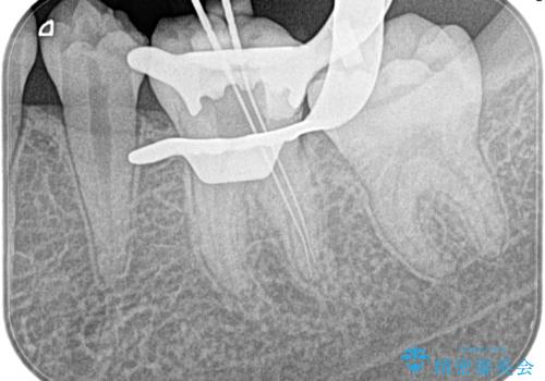 昨晩から激痛。精密根管治療の治療後