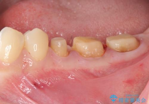 深い虫歯　歯周外科を併用した精度の高い補綴治療の治療中