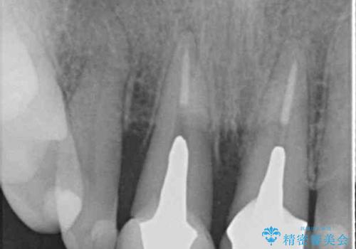 折れてしまった前歯 オールセラミックブリッジで自然な口元にの治療前