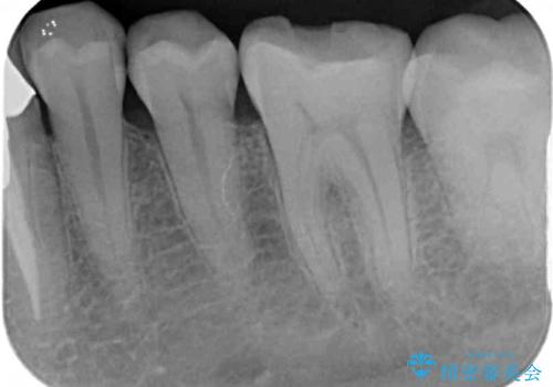 舌側の骨隆起切除とセラミックインレーによるむし歯治療の治療前