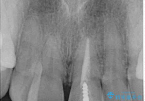 前歯のクロスバイトと変色した歯 ワイヤー矯正とセラミック治療の治療中