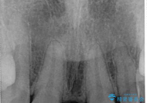 欠損歯と矮小歯 矯正治療と前歯のセラミック治療の治療前
