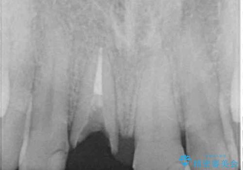 折れてしまった前歯 インプラントによる補綴治療の治療前