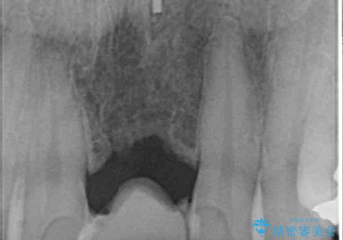 前歯のブリッジが気に入らない　歯肉移植術を併用した前歯のブリッジの治療前