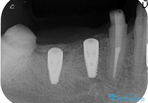 インプラント　抜歯になってしまった歯の補綴の治療後