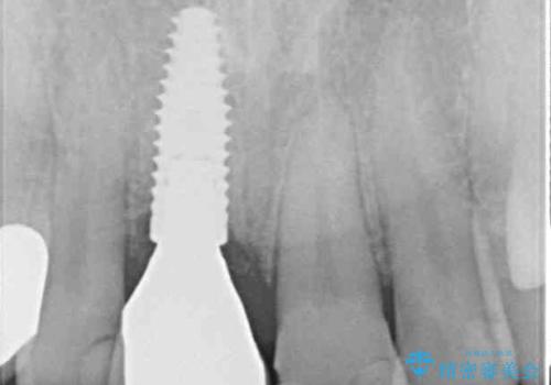 折れてしまった前歯 インプラントによる補綴治療の治療後