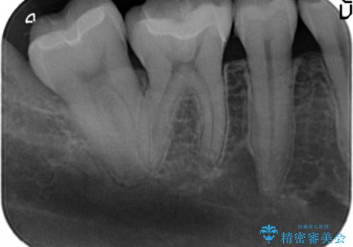 笑った時に見える銀歯を白くしたいの治療後