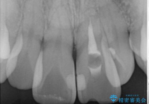 歯の変色 前歯の審美改善の治療前