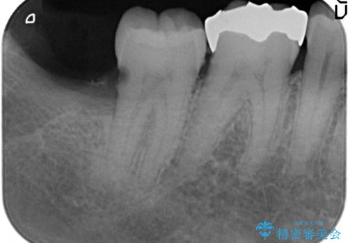 PGA(ゴールド)インレー 深い虫歯の治療の治療前