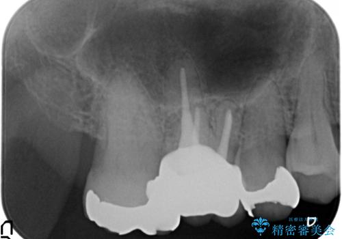 オールセラミッククラウン 銀歯と歯茎の隙間が気になるの治療後