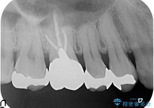 オールセラミッククラウン ズキズキ痛む歯の治療の治療前