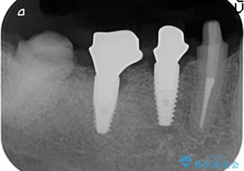 インプラント 抜歯になってしまった歯の補綴の治療中