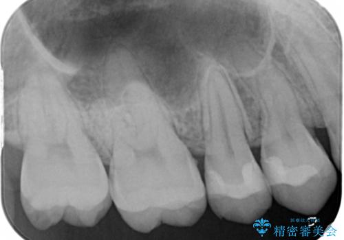 広範囲にわたる虫歯をセラミックで治療の治療前