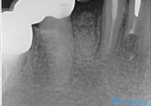 吸収した骨の再生 前歯部インプラント治療の治療中