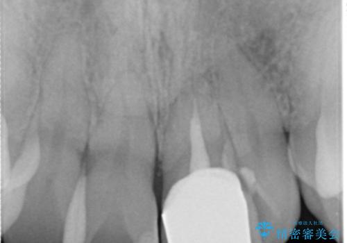 歯の変色 前歯の審美改善の治療後