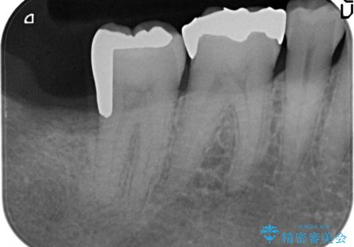 PGA(ゴールド)インレー　深い虫歯の治療の治療後