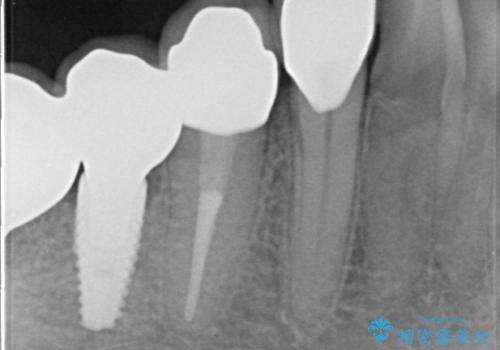 インプラント　抜歯になってしまった歯の補綴の治療後