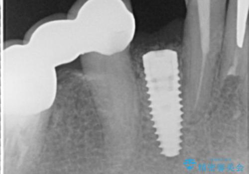 吸収した骨の再生 前歯部インプラント治療の治療中