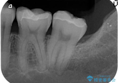 見える銀歯を白くの治療後