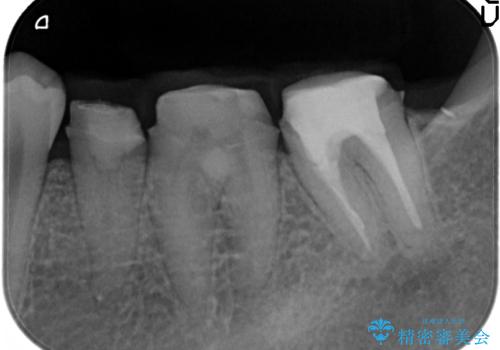 深い虫歯　歯周外科を併用した精度の高い補綴治療の治療中