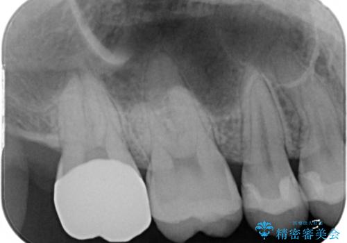 広範囲にわたる虫歯をセラミックで治療の治療後