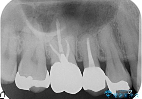 オールセラミッククラウン ズキズキ痛む歯の治療の治療後