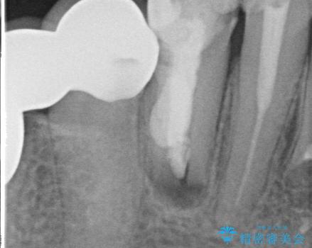 吸収した骨の再生　前歯部インプラント治療の治療前