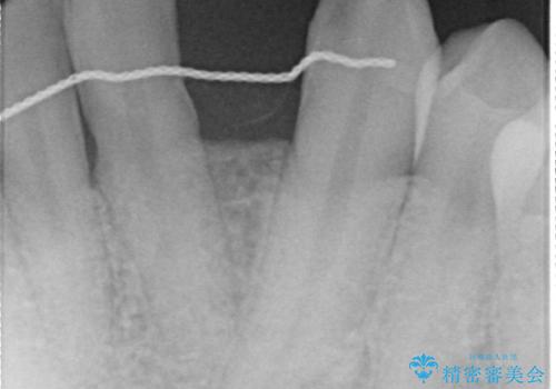 オールセラミッククラウン 矯正で綺麗に並ばなかった前歯の補綴の治療前