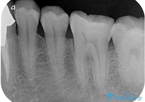 舌側の骨隆起切除とセラミックインレーによるむし歯治療の治療後