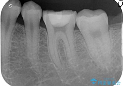 オールセラミッククラウン　他院にて抜歯を提案された歯の治療の治療前