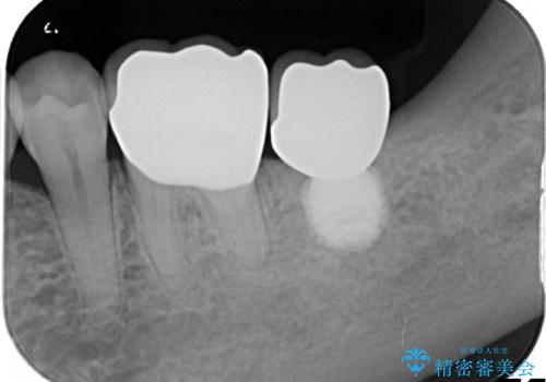 失った歯のインプラントでの咬合回復の治療後