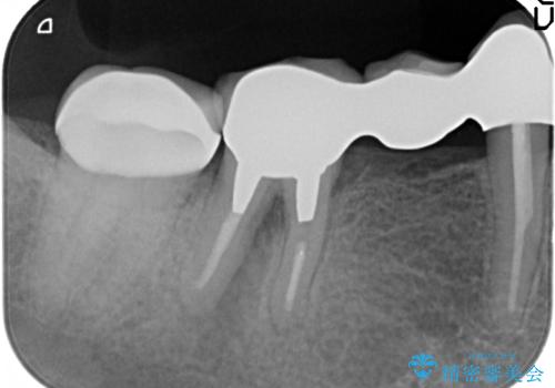 インプラント　抜歯になってしまった歯の補綴の治療前