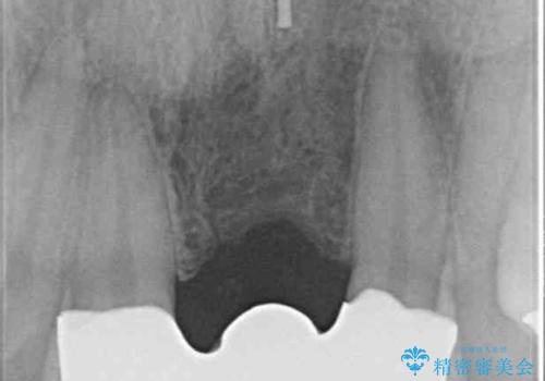 前歯のブリッジが気に入らない 歯肉移植術を併用した前歯のブリッジの治療後