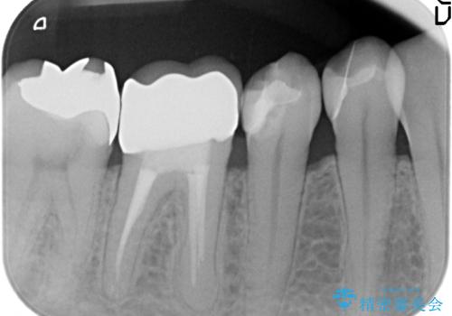 つめものが取れたのを放置 神経の治療からやりかえの治療後