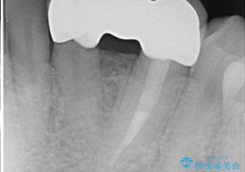 オールセラミッククラウン 矯正で綺麗に並ばなかった前歯の補綴の治療後