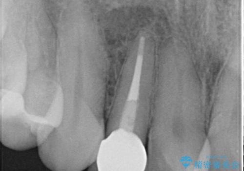 オールセラミッククラウン 変色が気になる前歯の治療の治療後