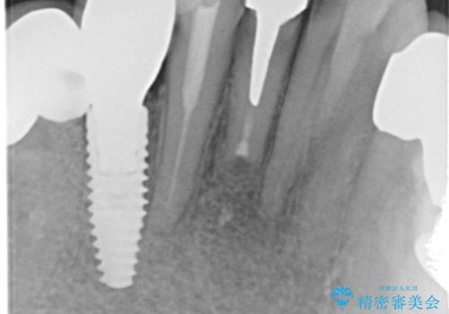 吸収した骨の再生 前歯部インプラント治療の治療後