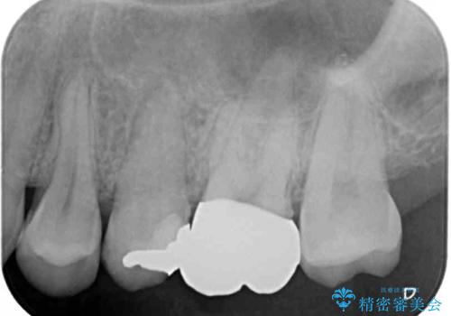 目立つ銀歯を治したい 奥歯のむし歯治療の治療後