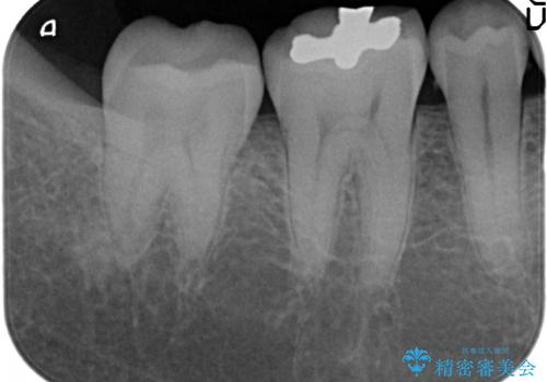 セラミックインレー 冷たいものがしみる奥歯の治療の治療前
