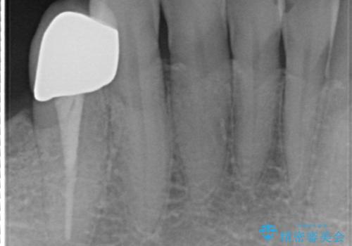 インプラント 抜歯になってしまった歯の補綴の治療前
