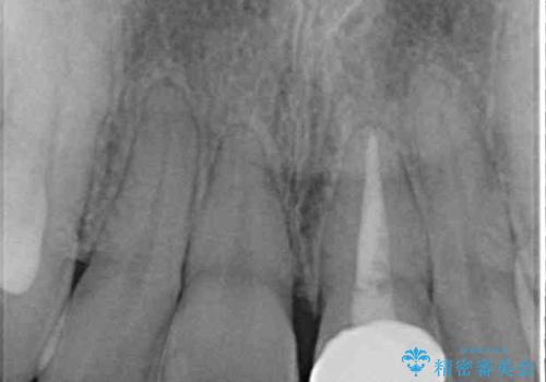 前歯のクロスバイトと変色した歯 ワイヤー矯正とセラミック治療の治療後
