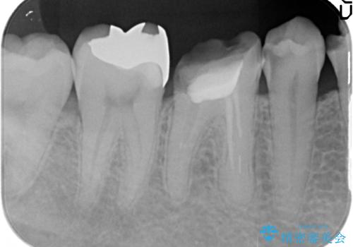 つめものが取れたのを放置 神経の治療からやりかえの治療前