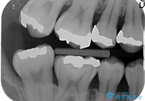 笑った時に見える銀歯を白くしたいの治療前