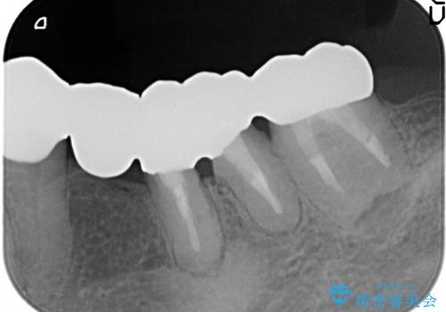 どうしても抜歯したくない　歯根分割術・骨外科手術で歯を残す　50代女性の治療後