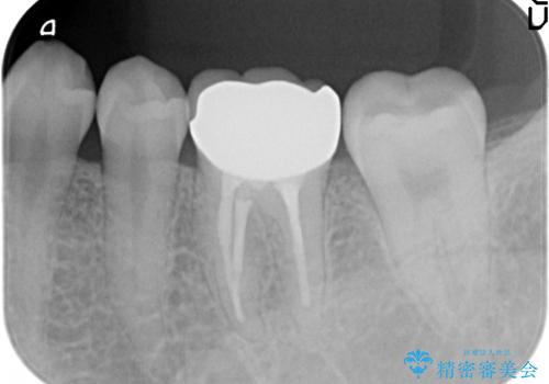 オールセラミッククラウン　他院にて抜歯を提案された歯の治療の治療後
