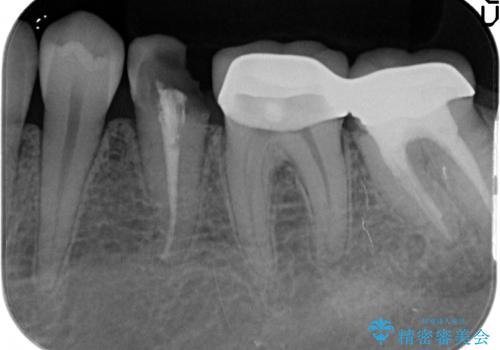 深い虫歯　歯周外科を併用した精度の高い補綴治療の治療前
