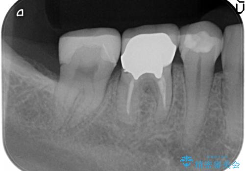 オールセラミッククラウン　他院にて抜歯を勧められた歯の治療の治療前