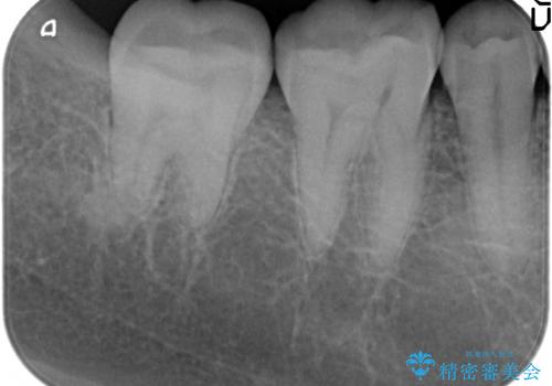 セラミックインレー 冷たいものがしみる奥歯の治療の治療後