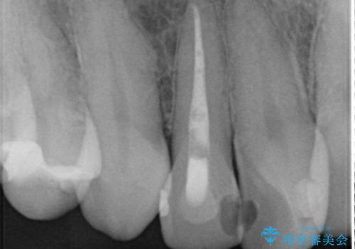 オールセラミッククラウン 変色が気になる前歯の治療の治療前