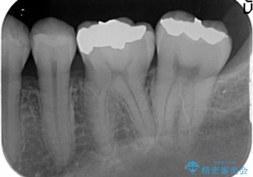 見える銀歯を白くの治療前